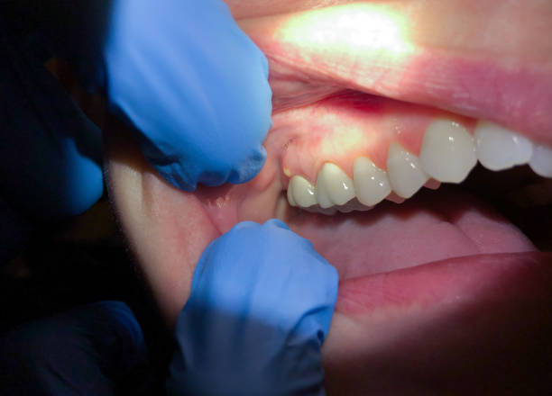 Best Emergency Root Canal Treatment in Chico, CA